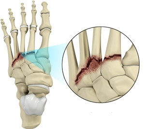 Surgical Techniques In Lisfranc Injuries | CENTROKINETIC