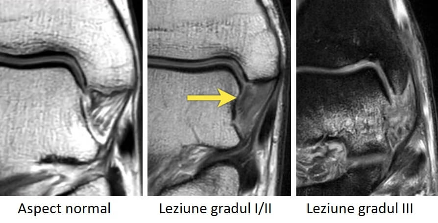 Deltoid Ligament Reconstruction Centrokinetic 9464