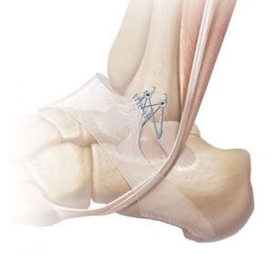 Bostrom Technique For Reconstruction Of The Anterior Talo-Fibular ...