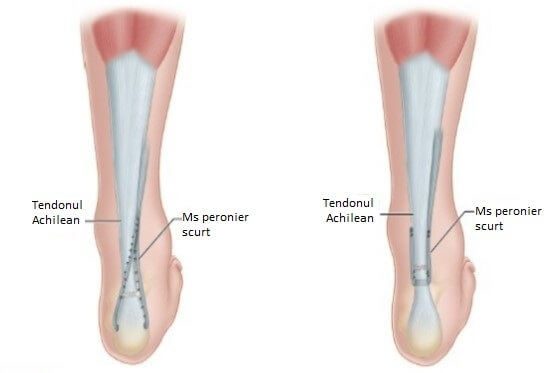 achilean-tendon-suturing-techniques-centrokinetic