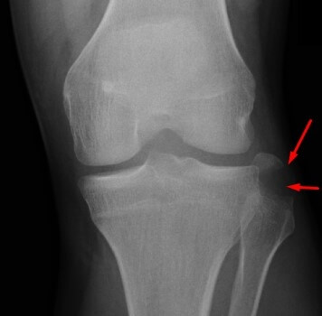 Reconstruction Of The Postero-External Knee Area | CENTROKINETIC