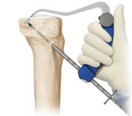 Rear Cross Link Reconstruction | CENTROKINETIC