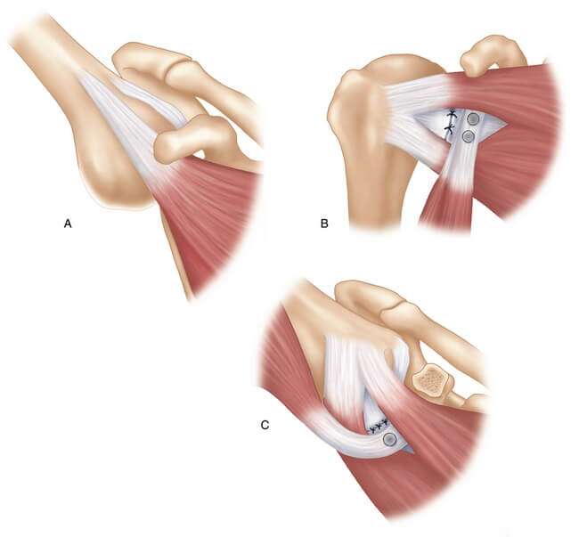 Latarjet Technique For Shoulder Dislocation