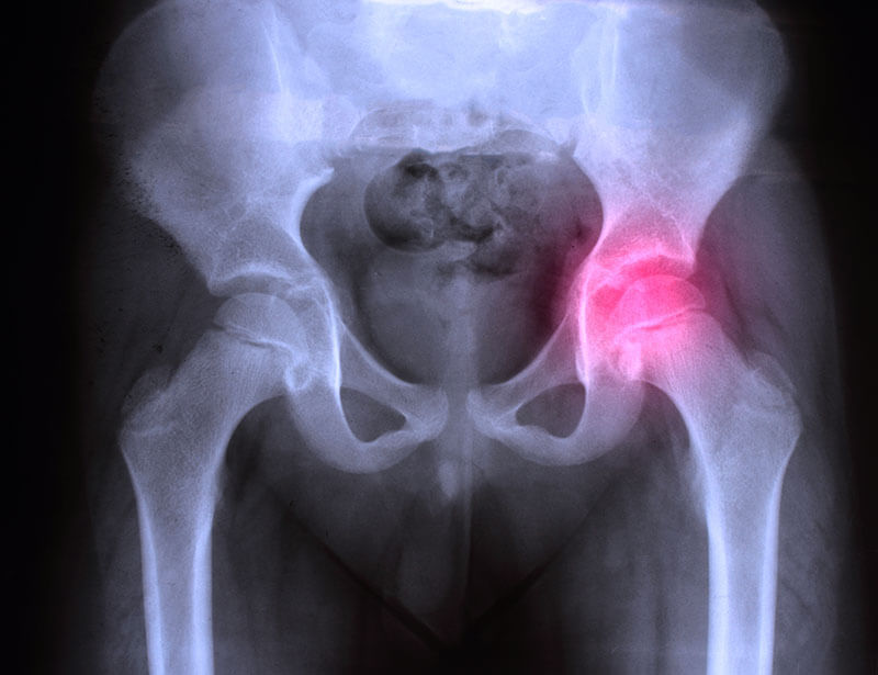 radiografie coxartroza