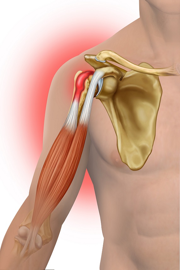Diagnosticul tendinitei calcificante Diagnosticul tendinitei calcificante