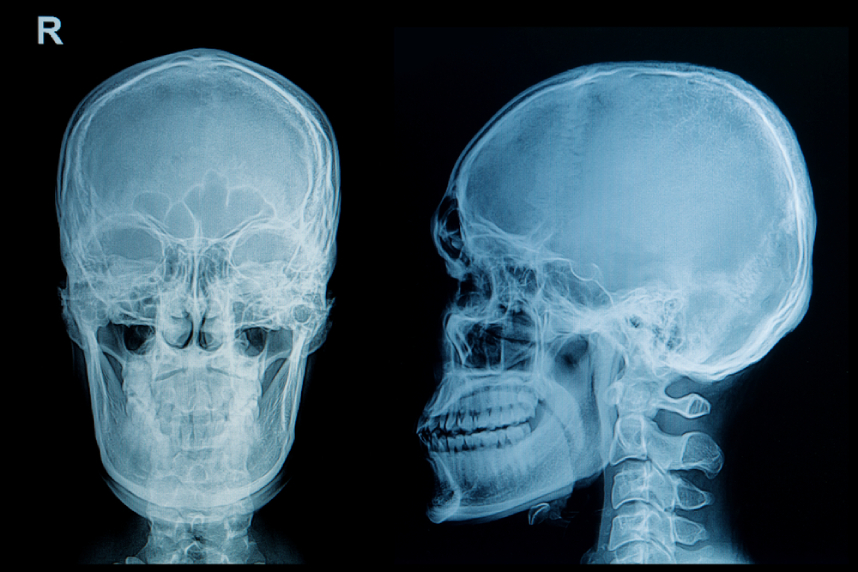 Brahicefalia: definitie, cauze, simptome si tratament