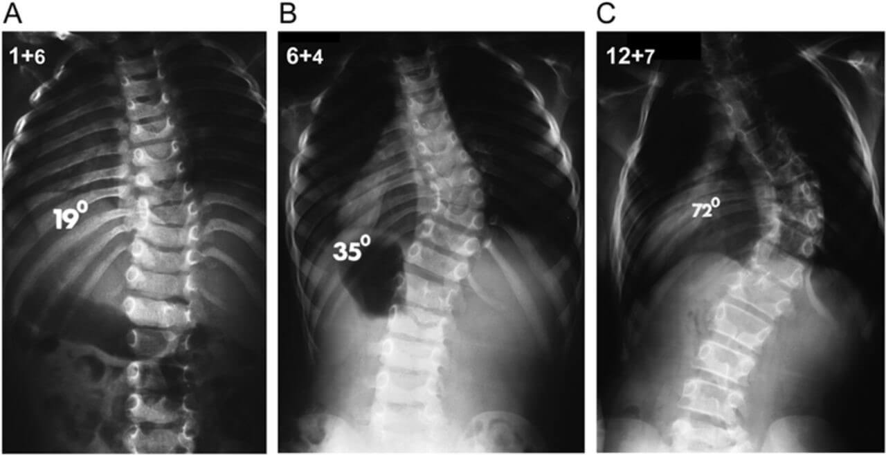 Сколиоз 3 степени фото рентген