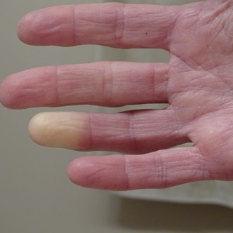 sindromul raynaud