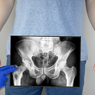 osteoporoza articulațiilor