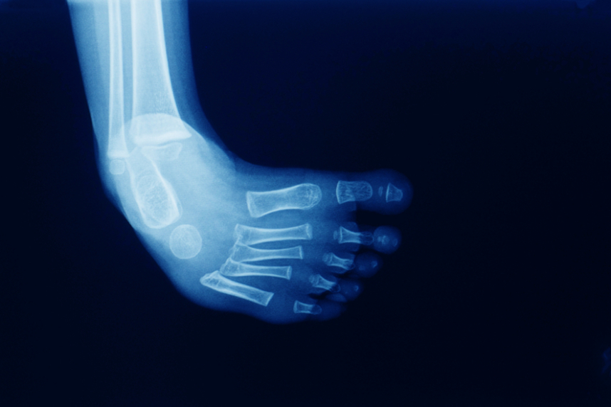 Diagnosticarea metatarsus adductus