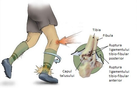 Deltoid Ligament Repair