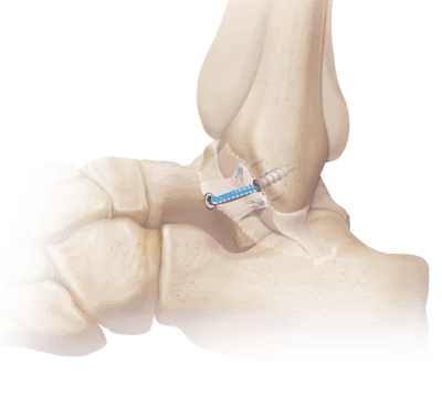 durere severă în timpul fracturii în articulația gleznei tratament comun pe lac