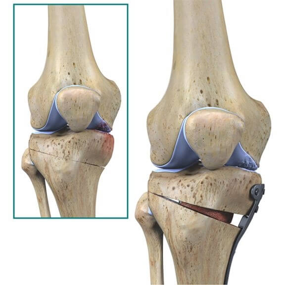 dureri de oase la picioare pregătirea articulațiilor și a ligamentelor la vârstnici