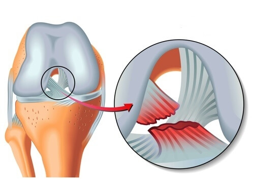 leziuni ale ligamentului de șold