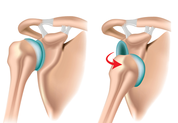 tratament de reabilitare postoperatorie a articulației umărului artroza 2 stadiul articulației umărului