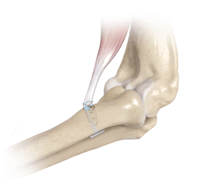 artroza blocului articulației cotului
