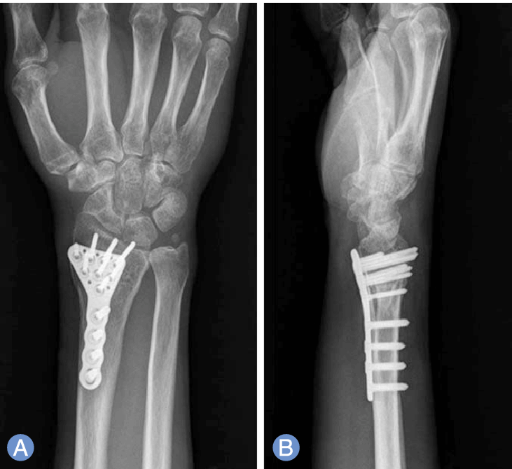 icd 10 distal radius fracture