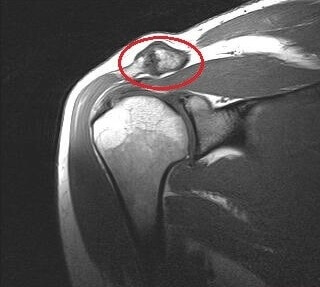 Artroza acromioclavicular tratament. Artroza acromio-claviculară - Shoulder & Knee Surgery