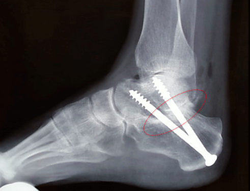 artrodeza restaurării articulației gleznei terapie cu nămol pentru dureri articulare