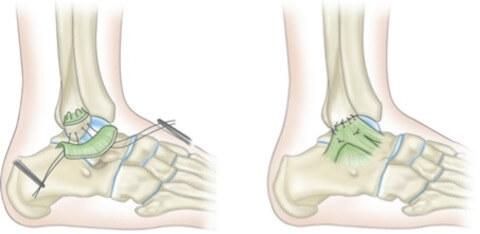 Arthrex - Deltoid Ligament Reconstruction