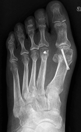 fractură de mână cu tratament de deplasare leziuni și boli ale articulației gleznei