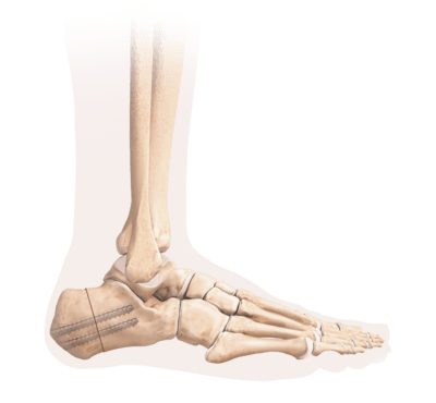 Al pielii piciorul lateral exterior