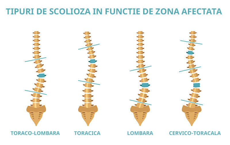 Tot Ce Trebuie Sa Stii Despre Scolioza La Adulti Si Copii