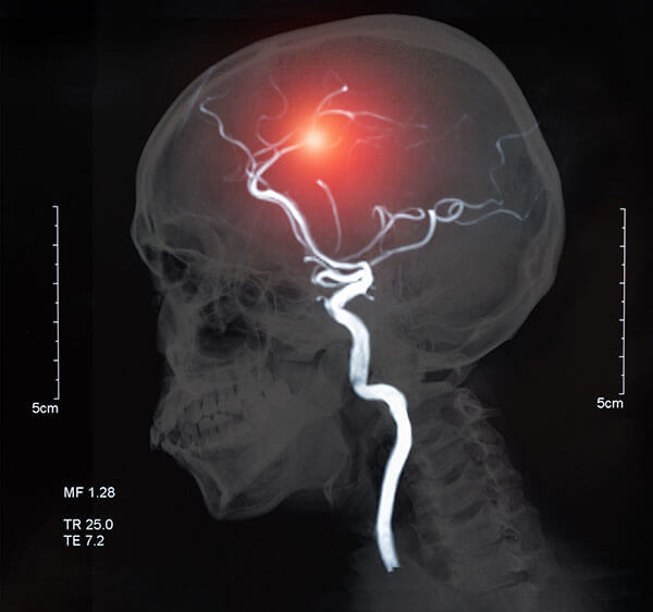 Atacul Vascular Cerebral Simptome Si Tratament Centrokinetic