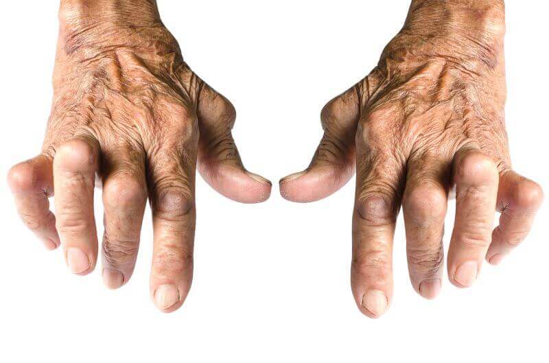 simptomele și tratamentul degetelor artritei dacă articulațiile doare de frig