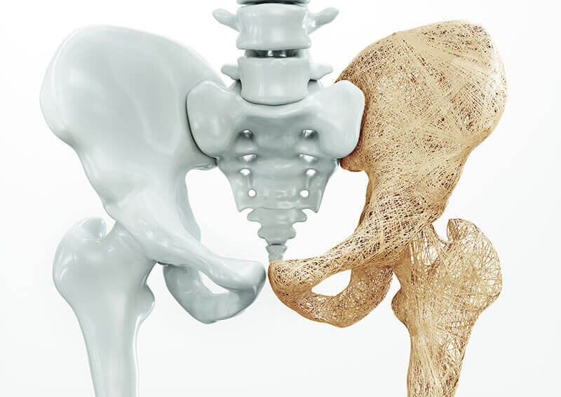 Osteoporoza - Tratament Naturist