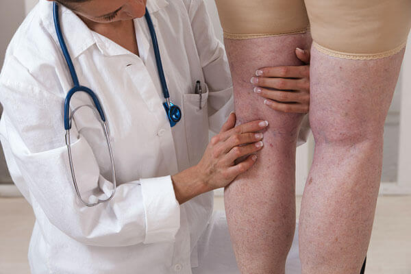tratament pentru picioare umflate sub genunchi