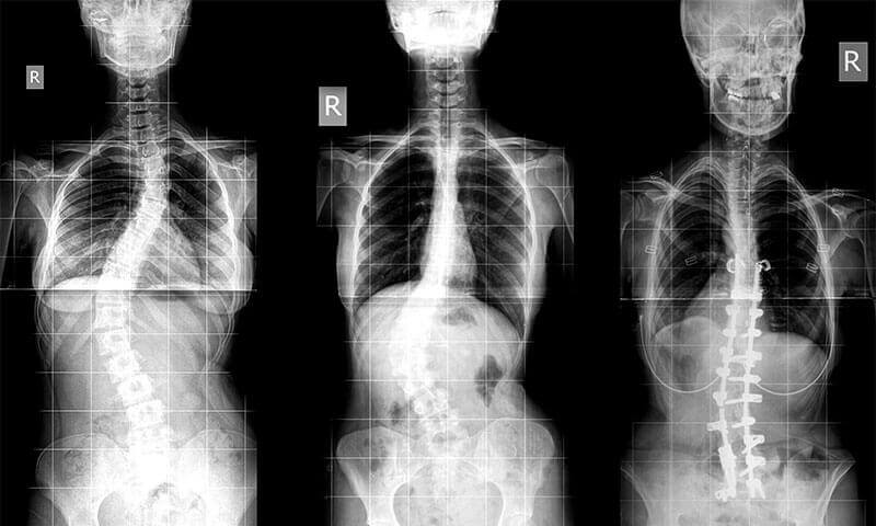 Radiografie pacient scolioza coloana vertebrala