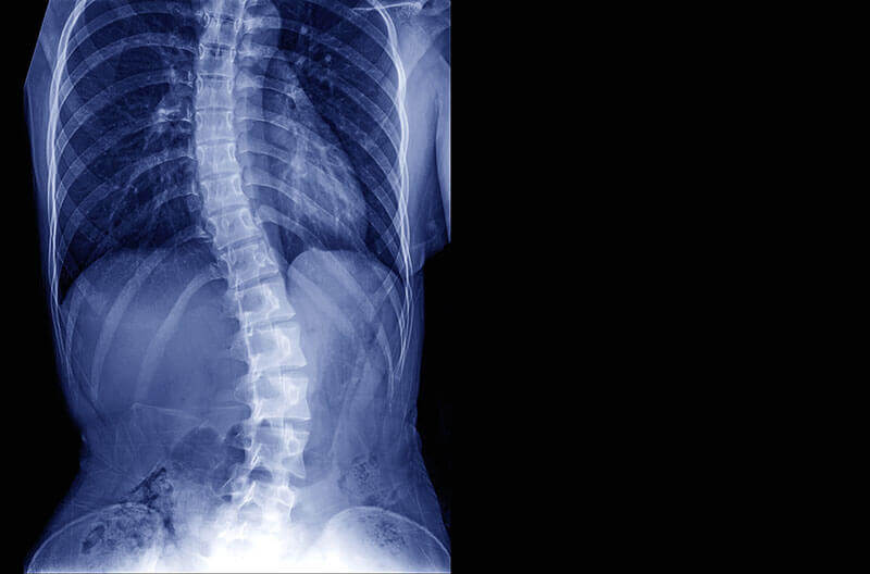 Radiografie coloana vertebrala tipuri de scolioza