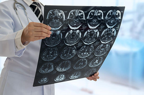 Boala Alzheimer Centrokinetic