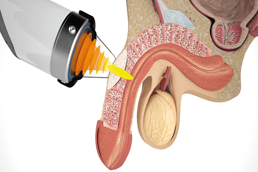 Disfunctia erectila – tratament nou la Medicover