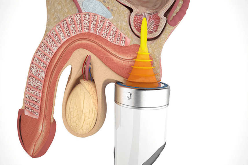 Disfunctia erectila – tratament nou la Medicover