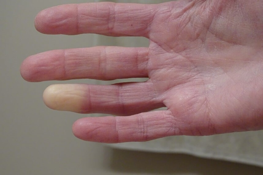 simptomele sindromului Raynaud