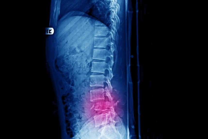 Cauda Equina Syndrome