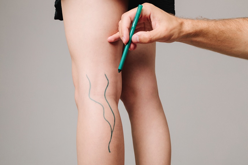 Chirurgie vasculara
