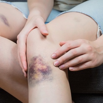 primul-ajutor-contuzii