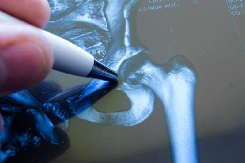 diagnosticare coxartroza