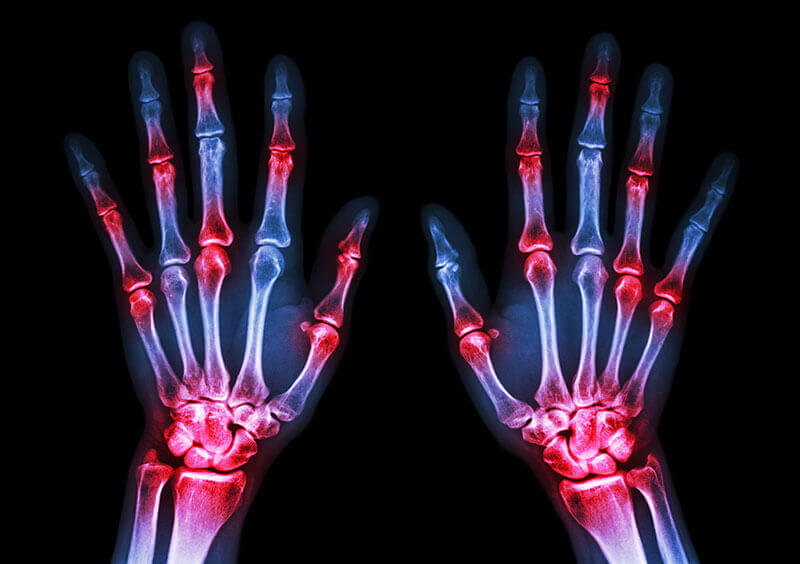 radiografie poliartrita reumatoida