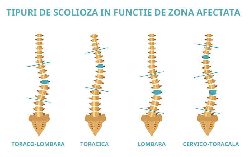 Tipuri de scolioza in functie de zona afectata