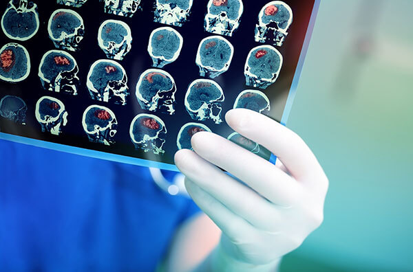 diagnosticare cauze avc