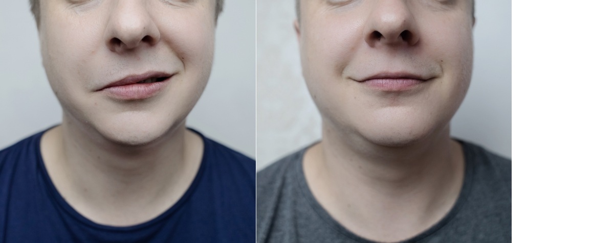inainte si dupa recuperare pentru pareza faciala