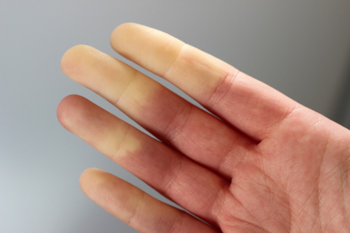 Distinctive sign of Raynaud's phenomenon